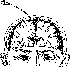 Brain (551 General diagnostics of brain diseases): figure 49 from the 1928–1936 encyclopedia article