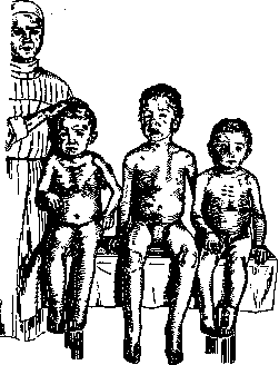 Starvation: figure 2 from the 1928–1936 encyclopedia article