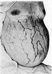 Granulomas: figure 4 from the 1928–1936 encyclopedia article