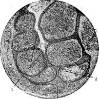 Granulomas: figure 1 from the 1928–1936 encyclopedia article