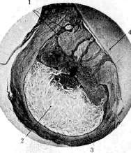 Granulomas: figure 2 from the 1928–1936 encyclopedia article