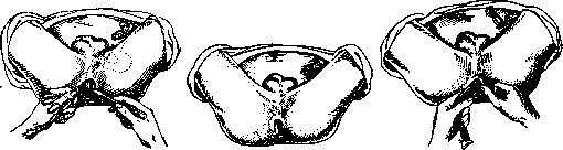 Demucosation: figure 1 from the 1928–1936 encyclopedia article