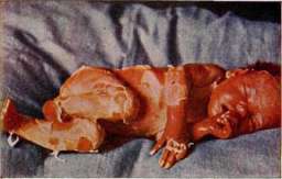 Dermatitis: figure 3 from the 1928–1936 encyclopedia article