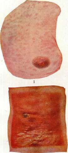 Dermatitis: figure 1 from the 1928–1936 encyclopedia article