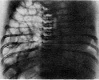 Diaphragm: figure 8 from the 1928–1936 encyclopedia article