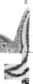 Hydatidiform Mole: figure 1 from the 1928–1936 encyclopedia article