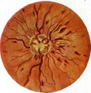 Papilledema: figure 3 from the 1928–1936 encyclopedia article