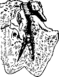 Foreign Bodies: figure 3 from the 1928–1936 encyclopedia article