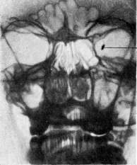 Foreign Bodies: figure 4 from the 1928–1936 encyclopedia article