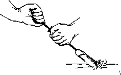 Lithotripsy: figure 8 from the 1928–1936 encyclopedia article