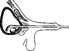 Lithotripsy: figure 10 from the 1928–1936 encyclopedia article