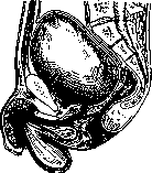 Lithotomy: figure 4 from the 1928–1936 encyclopedia article
