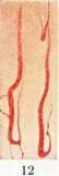 Capillaroscopy: figure 6 from the 1928–1936 encyclopedia article
