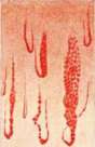 Capillaroscopy: figure 5 from the 1928–1936 encyclopedia article