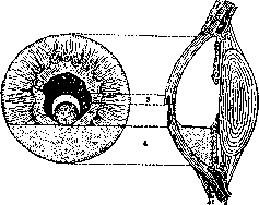 Keratitis: figure 5 from the 1928–1936 encyclopedia article
