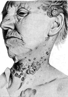 Keratoses: figure 3 from the 1928–1936 encyclopedia article