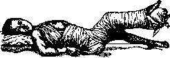 Pertussis: figure 21 from the 1928–1936 encyclopedia article