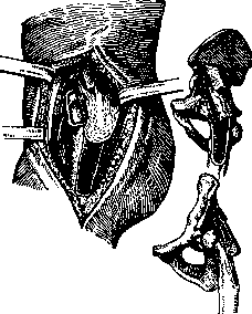 Pertussis: figure 27 from the 1928–1936 encyclopedia article
