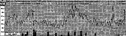 Pertussis: figure 10 from the 1928–1936 encyclopedia article