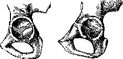 Pertussis: figure 11 from the 1928–1936 encyclopedia article