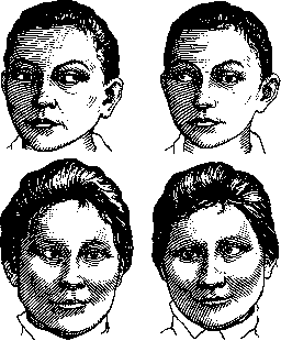 Strabismus: figure 4 from the 1928–1936 encyclopedia article