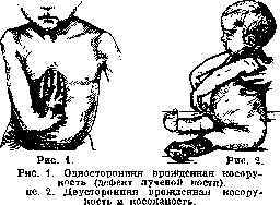 Cubitus Varus: figure 1 from the 1928–1936 encyclopedia article