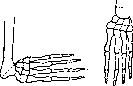 Cubitus Varus: figure 2 from the 1928–1936 encyclopedia article
