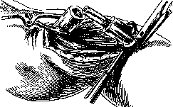 Bone Suture: figure 5 from the 1928–1936 encyclopedia article