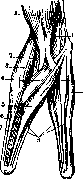 Krukenberg Hand: figure 2 from the 1928–1936 encyclopedia article