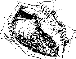 Laparotomy: figure 13 from the 1928–1936 encyclopedia article