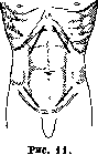 Laparotomy: figure 6 from the 1928–1936 encyclopedia article
