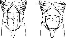 Laparotomy: figure 1 from the 1928–1936 encyclopedia article