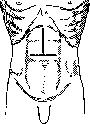 Laparotomy: figure 7 from the 1928–1936 encyclopedia article
