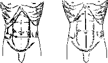 Laparotomy: figure 2 from the 1928–1936 encyclopedia article