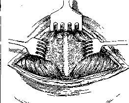 Laparotomy: figure 5 from the 1928–1936 encyclopedia article
