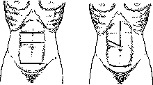 Laparotomy: figure 4 from the 1928–1936 encyclopedia article