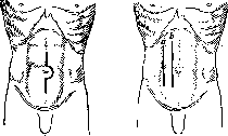 Laparotomy: figure 3 from the 1928–1936 encyclopedia article