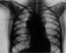 Lymphogranulomatosis: figure 5 from the 1928–1936 encyclopedia article
