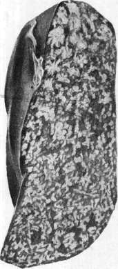 Lymphogranulomatosis: figure 1 from the 1928–1936 encyclopedia article