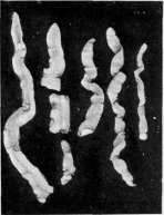 Lymphogranulomatosis: figure 3 from the 1928–1936 encyclopedia article