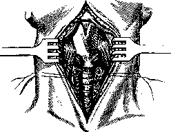 Laryngotomy: figure 1 from the 1928–1936 encyclopedia article