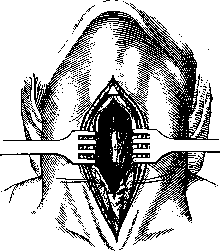 Laryngotomy: figure 2 from the 1928–1936 encyclopedia article