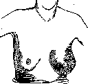 Mastitis: figure 1 from the 1928–1936 encyclopedia article