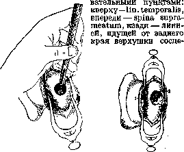 Mastoiditis: figure 3 from the 1928–1936 encyclopedia article