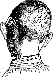 Mastoiditis: figure 1 from the 1928–1936 encyclopedia article