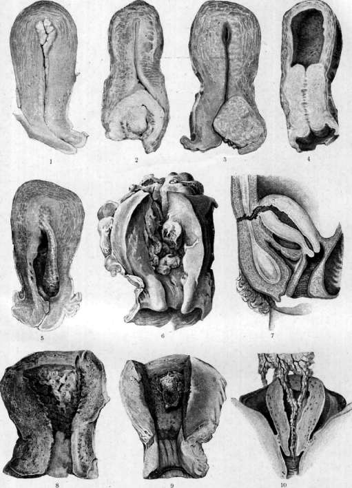 Uterus: figure 5 from the 1928–1936 encyclopedia article