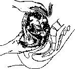Uterus: figure 17 from the 1928–1936 encyclopedia article