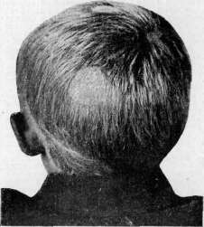 Myiasis (myiasis): figure 7 from the 1928–1936 encyclopedia article
