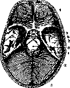 Cerebellopontine Angle: figure 24 from the 1928–1936 encyclopedia article
