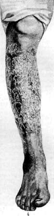 Emphysema: figure 3 from the 1928–1936 encyclopedia article